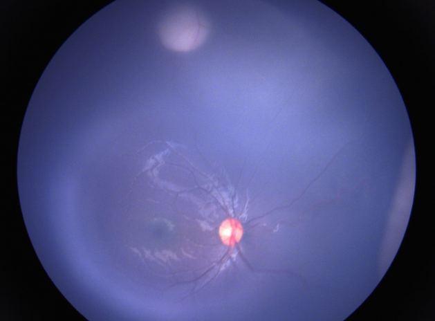 視網(wǎng)膜母細胞瘤