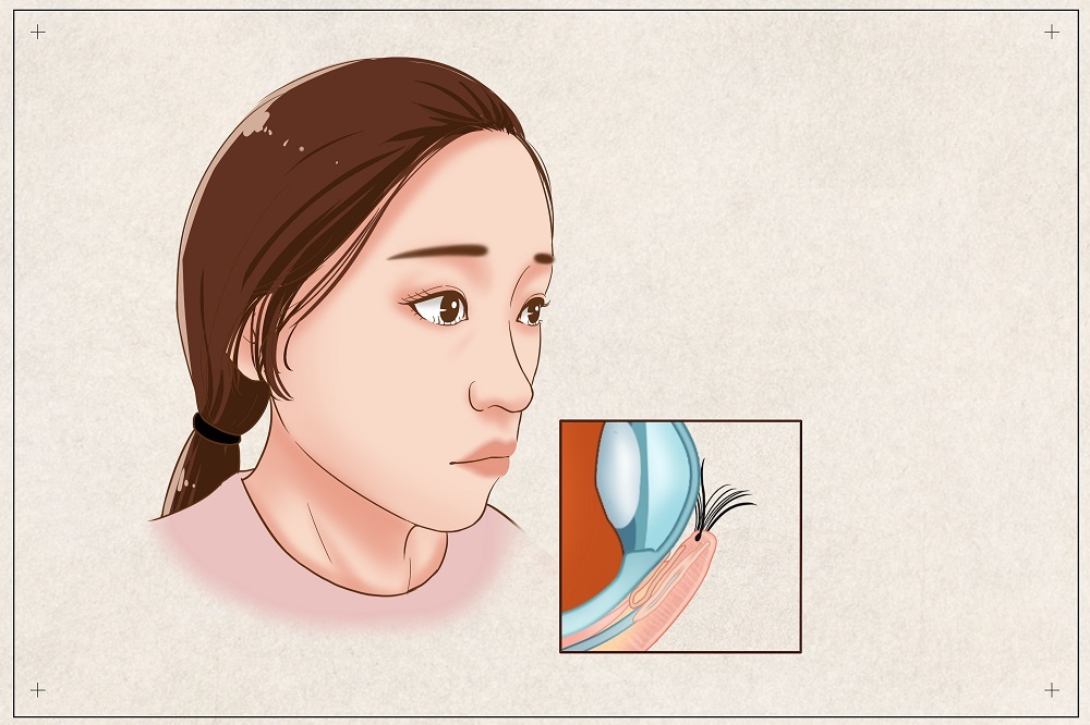 倒睫會自己好嗎？