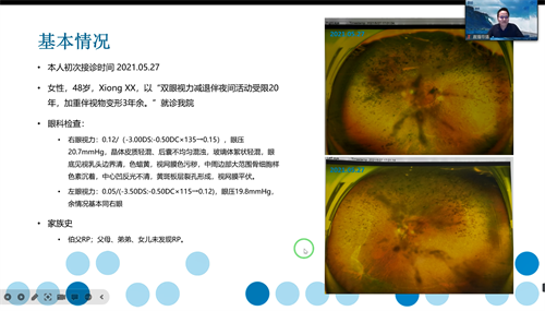 視網膜色素變性